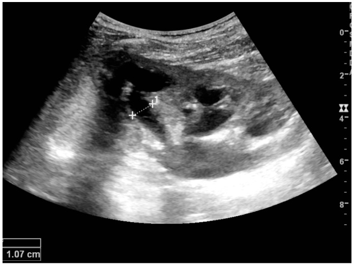 Ultrassom de rim em corte longitudinal com pelve e cálices dilatados e anecoicos, parênquima afilado e medida da largura de um cálice de 1,07 cm