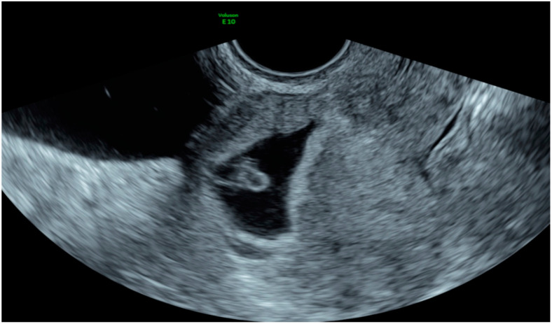 Ultrassom transvaginal de gravidez em cicatriz de cesárea: saco gestacional com embrião na porção ístmica anterior do útero, sobre o local da cicatriz, envolto pelo miométrio