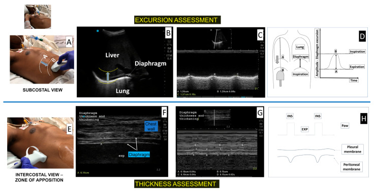 Técnica do ultrassom do diafragma em paciente em ventilação mecânica: transdutor subcostal e modo M para excursão na linha superior; transdutor linear intercostal na zona de aposição, com o diafragma hipoecoico entre pleura e peritônio, e modo M para espessura e espessamento na linha inferior