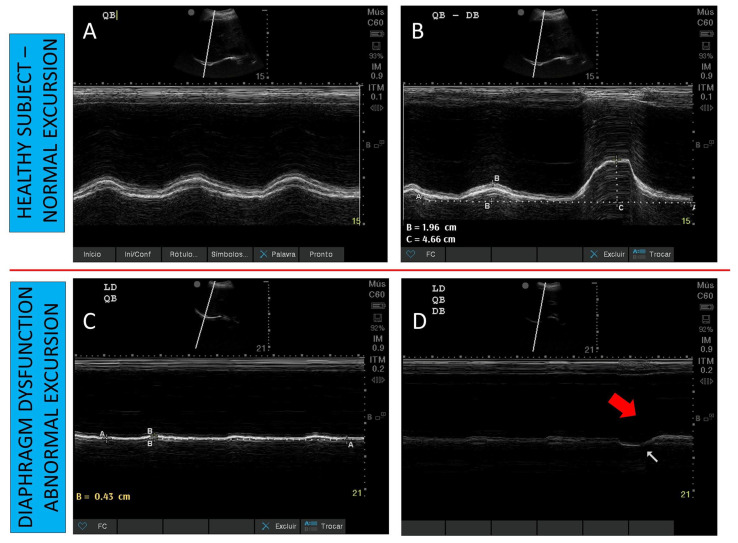 Ultrassom do diafragma no modo M: excursão normal em respiração tranquila e profunda em indivíduo saudável (A, B), excursão reduzida de 0,43 cm (C) e movimento ausente com deslocamento paradoxal na inspiração profunda (D) em pacientes com disfunção diafragmática