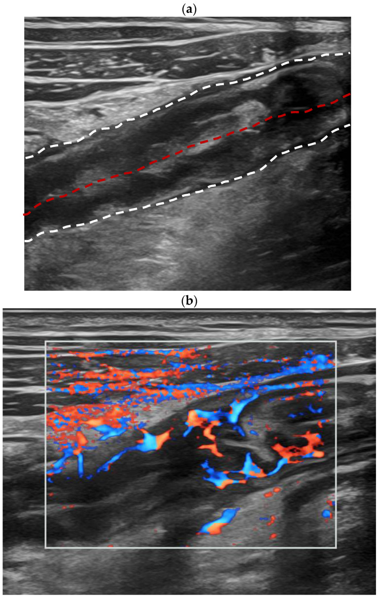 Ultrassom intestinal de doença de Crohn ativa: corte longitudinal do íleo com parede de 6,0 mm e estratificação indistinta, e Doppler colorido com sinais vasculares longos na parede conectados ao mesentério
