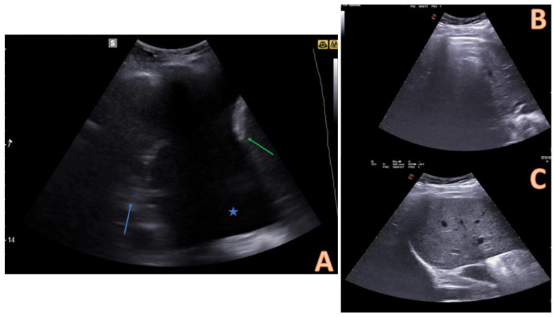 Ultrassom de derrame pleural: espaço anecoico acima do diafragma com pulmão atelectasiado no interior, ao lado de cortes de base pulmonar normal sem derrame