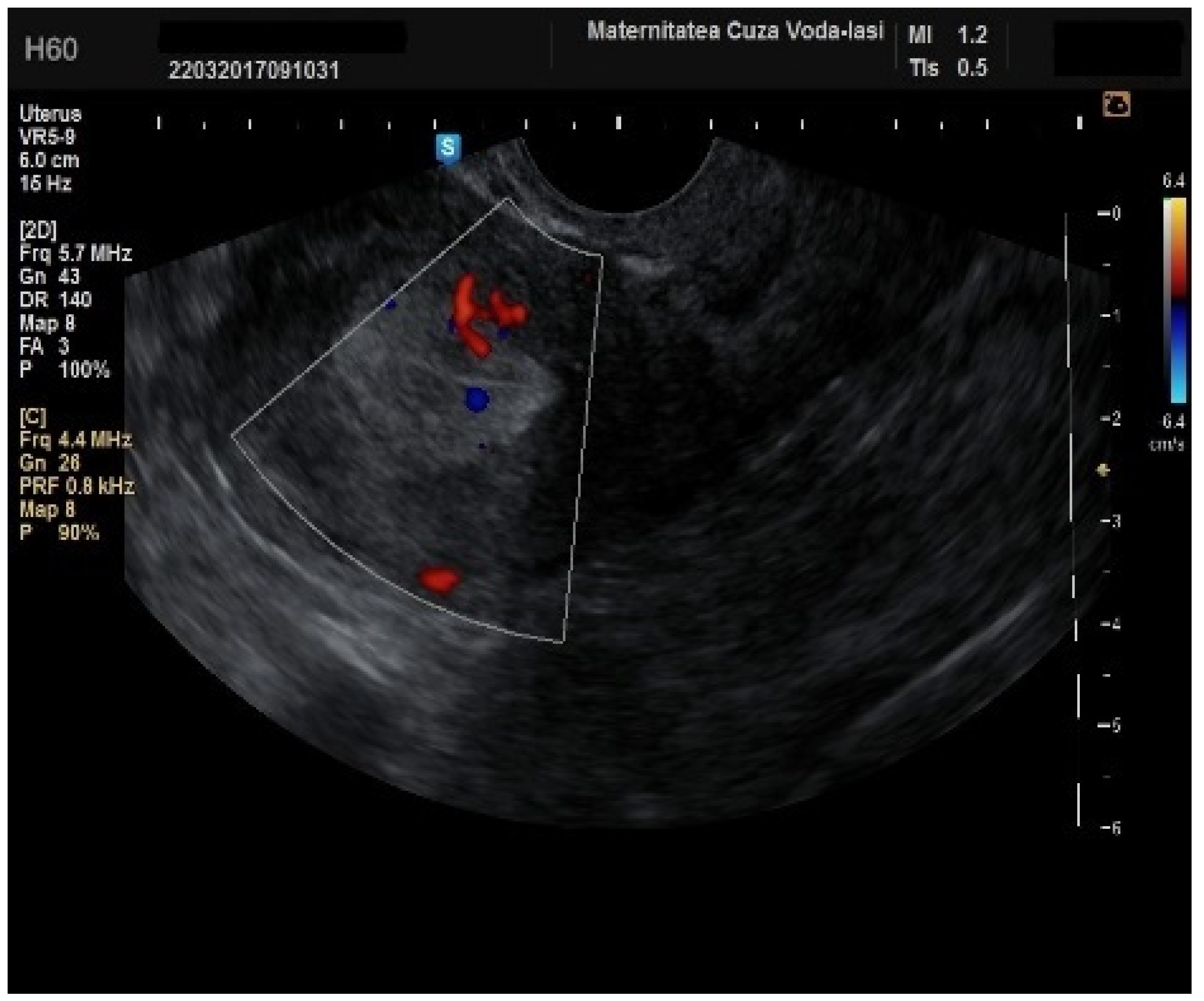 Ultrassom transvaginal com Doppler colorido mostrando pólipo endometrial nutrido por um vaso único que entra pela base da lesão