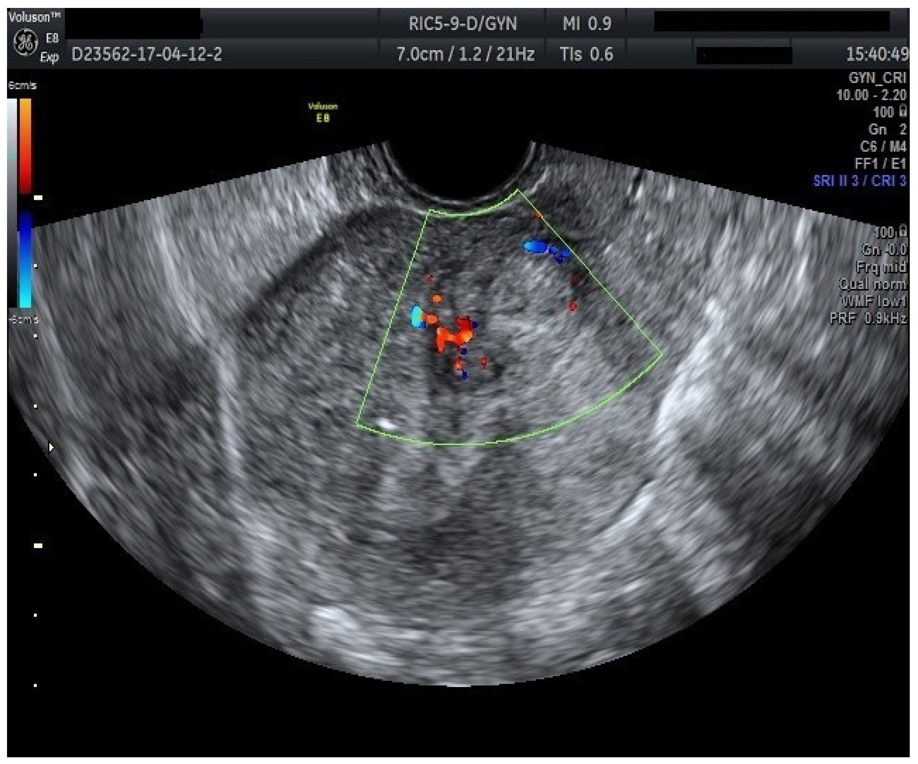 Ultrassom transvaginal com Doppler colorido mostrando mioma uterino arredondado com vasos contornando a lesão