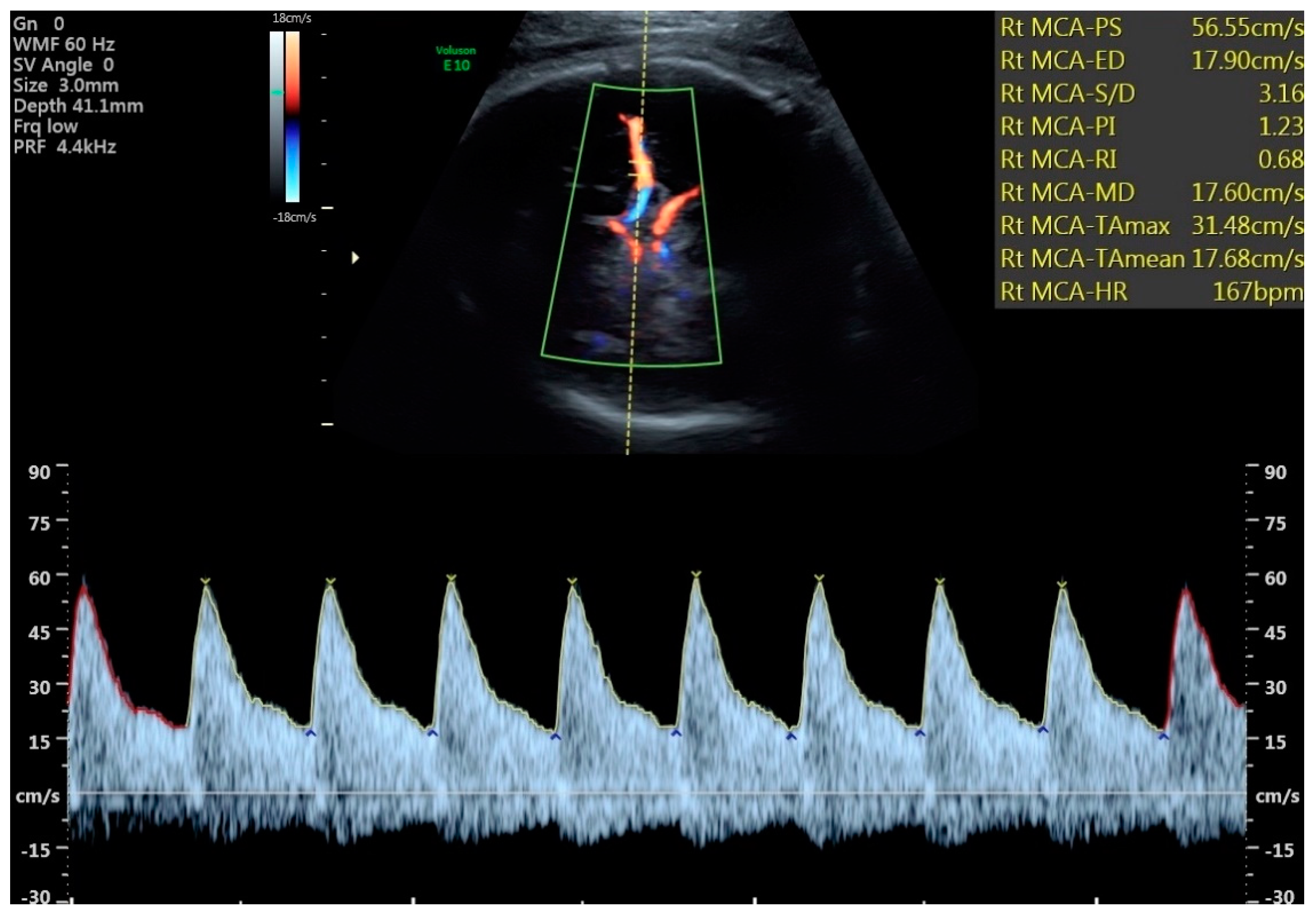 Doppler espectral da artéria cerebral média fetal com aumento do fluxo diastólico e índice de pulsatilidade baixo, padrão de centralização (brain sparing)