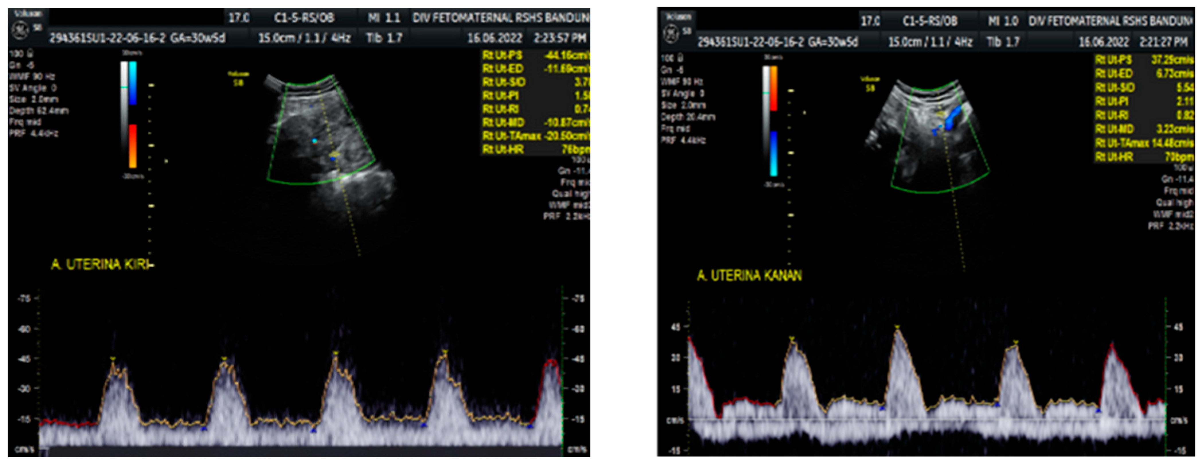 Doppler espectral das artérias uterinas direita e esquerda com incisura protodiastólica (notch), sinal associado a resistência placentária aumentada