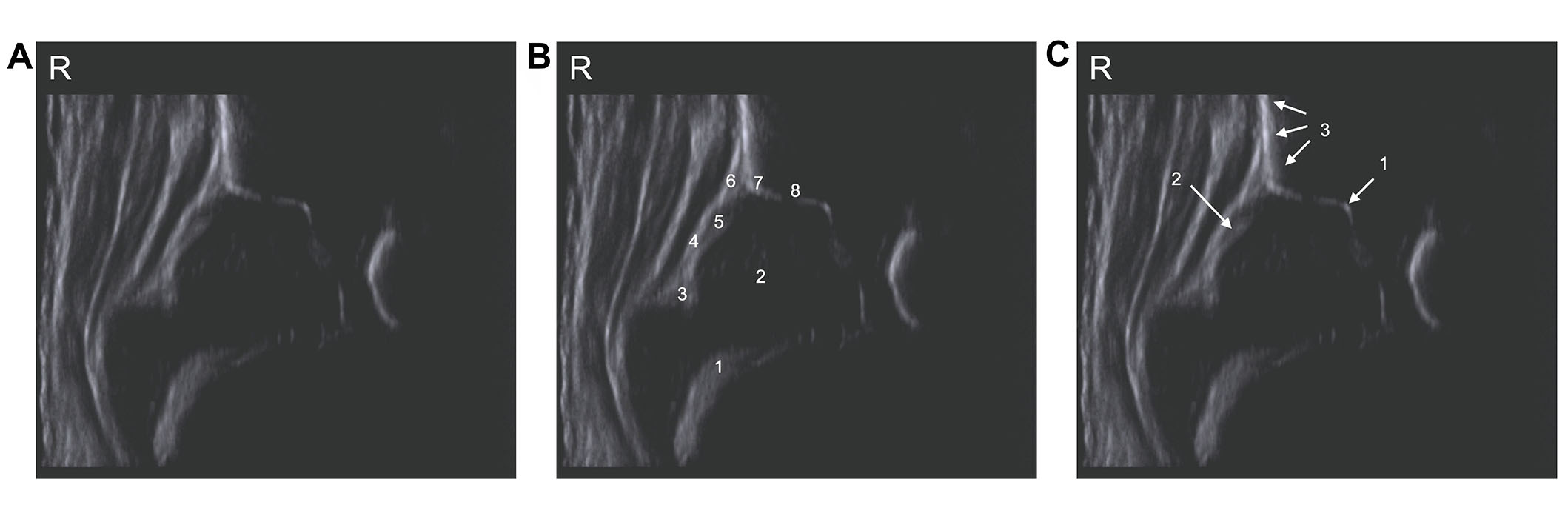Ultrassom coronal de quadril de bebê no plano padrão de Graf, com as estruturas anatômicas numeradas e os três pontos de checagem: borda inferior do ílio, lábio acetabular e silhueta reta do ílio