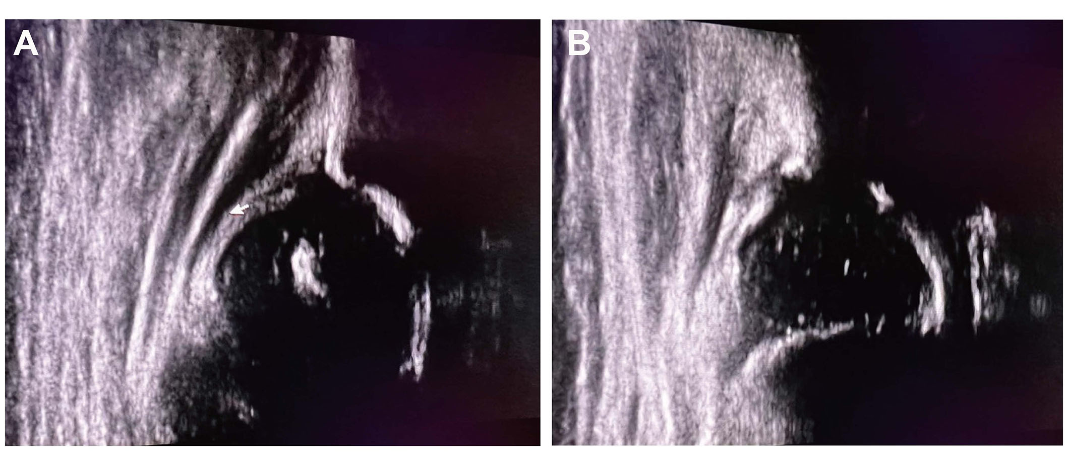 Dois cortes de ultrassom de quadril de bebê fora do plano padrão, um com inclinação anterior e outro com inclinação dorsal, em que nem todas as estruturas anatômicas são identificadas