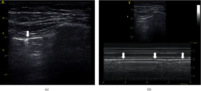 Ultrassom pulmonar com transdutor linear mostrando o ponto pulmonar no modo B (seta) e, no modo M, alternância entre sinal da praia e código de barras durante a respiração