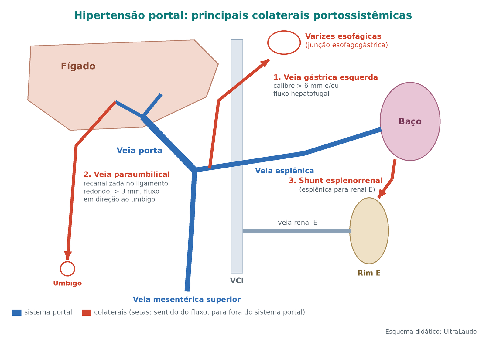 Esquema didático do sistema portal com as três colaterais mais vistas ao ultrassom: veia gástrica esquerda para varizes esofágicas, veia paraumbilical recanalizada para o umbigo e shunt esplenorrenal