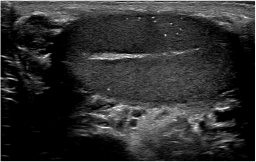 Ultrassom de testículo com calcificações puntiformes ecogênicas difusas no parênquima, aspecto característico de microlitíase testicular