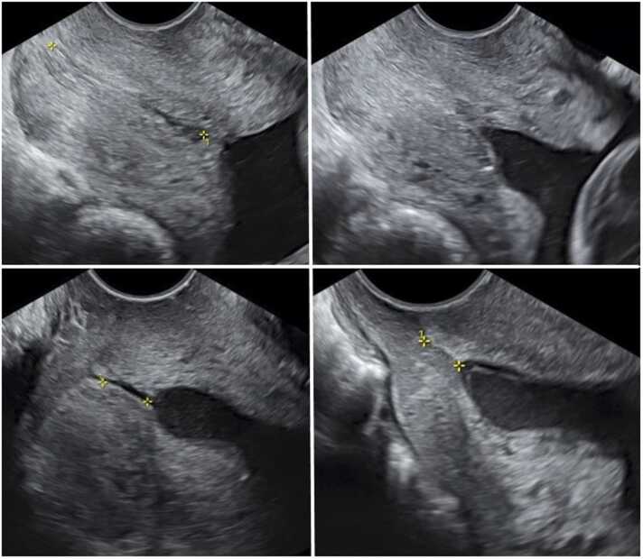 Quatro imagens transvaginais do colo uterino em corte sagital na mesma gestante: colo longo medido com calipers, abertura do orifício interno com protrusão das membranas sob pressão suprapúbica e colo progressivamente encurtado com funil