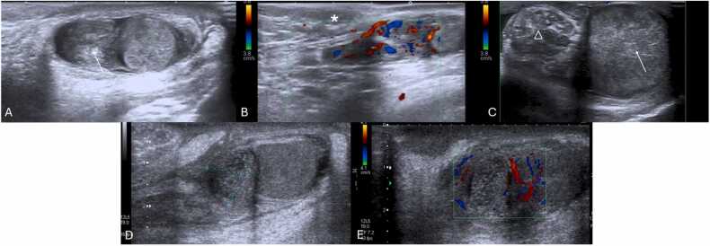 Cinco painéis de ultrassom escrotal: epidídimo aumentado com fluxo aumentado ao Doppler na epididimite, testículo e epidídimo aumentados sem fluxo na torção testicular e estrutura extratesticular arredondada avascular com testículo de fluxo preservado na torção do apêndice