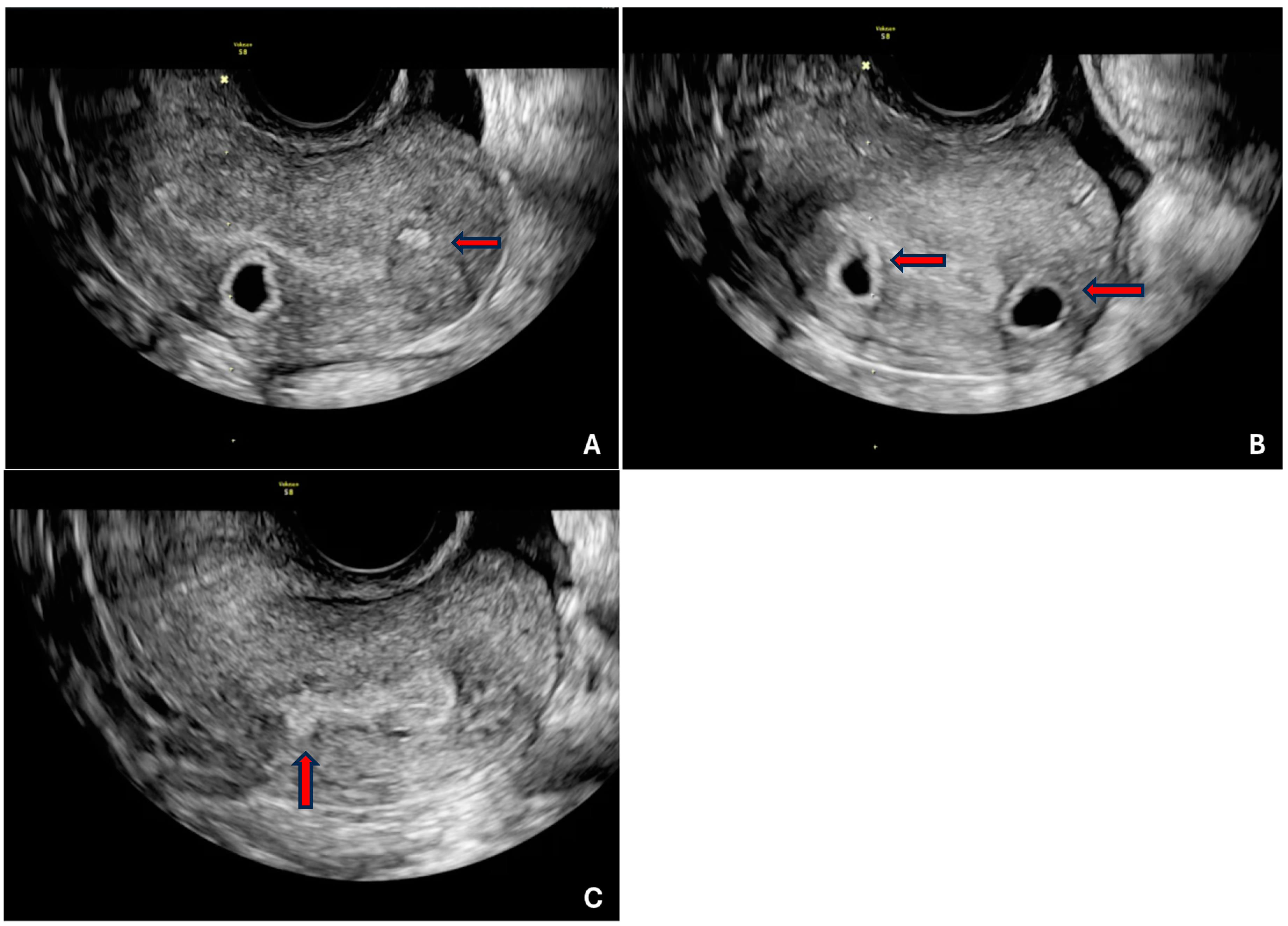 Ultrassom transvaginal do útero com sinais diretos de adenomiose: ilhas hiperecogênicas, cistos no miométrio e brotos ecogênicos subendometriais
