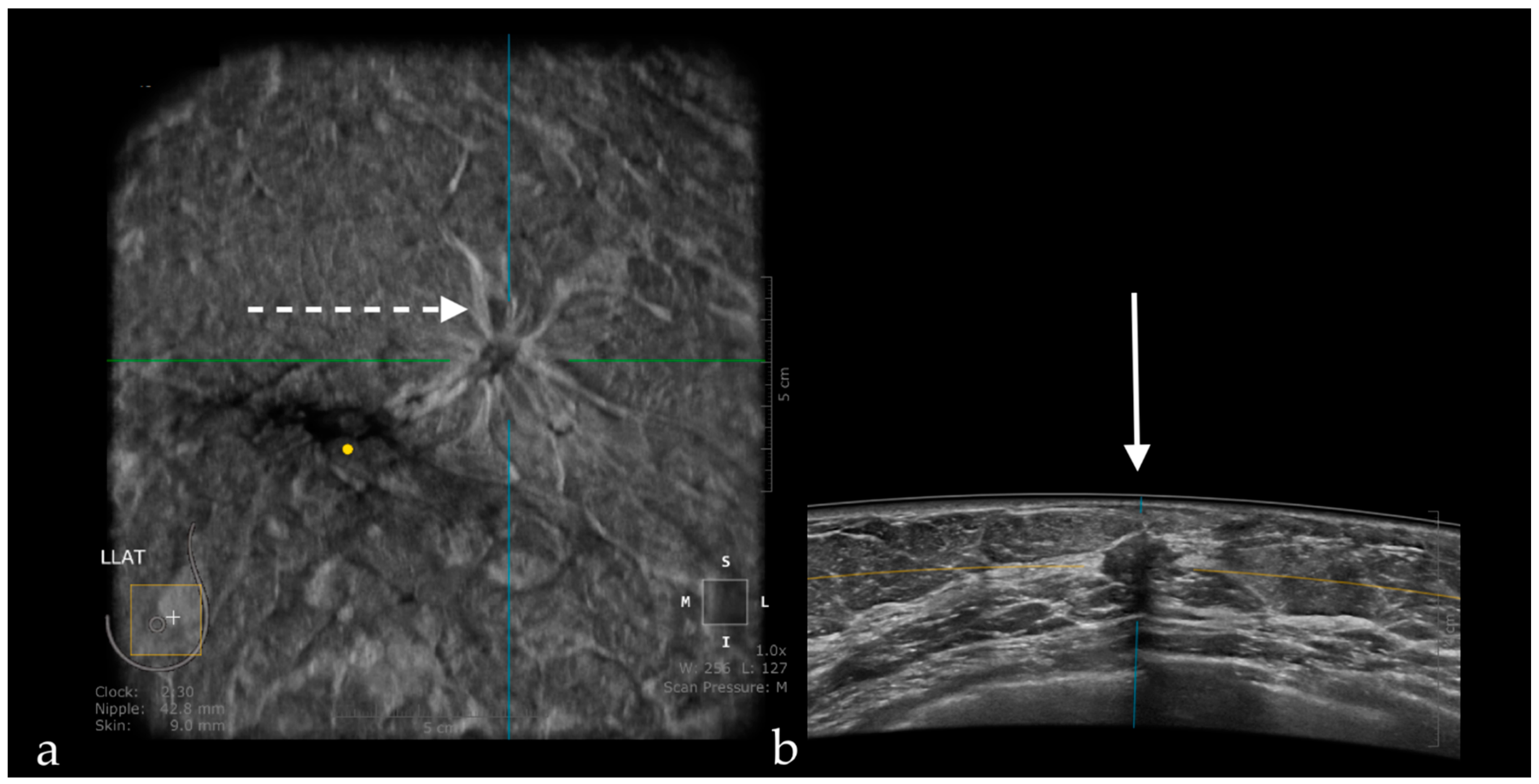 Ultrassom automatizado da mama (ABUS) em planos coronal e axial mostrando nódulo hipoecoico espiculado de carcinoma ductal invasivo
