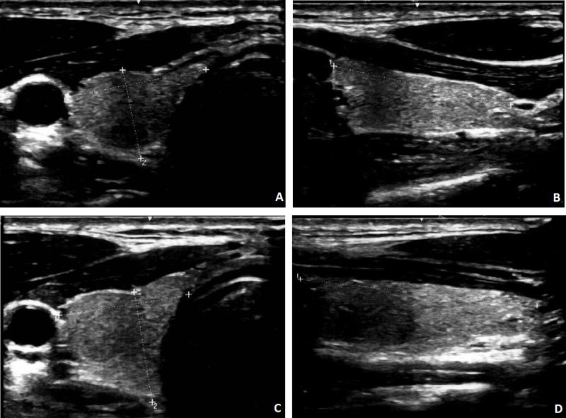 Ultrassom do lobo direito da tireoide em quatro painéis: cortes transversais com medidas da largura e do anteroposterior e cortes longitudinais com medida do comprimento, em dois exames sucessivos