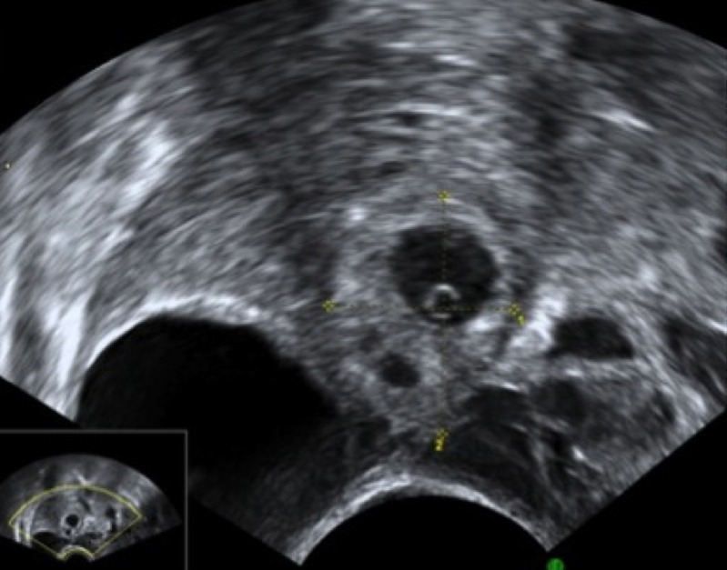 Ultrassom transvaginal de gravidez ectópica tubária direita com 6 semanas e 2 dias: saco gestacional extrauterino com halo ecogênico, entre os calipers, adjacente ao ovário direito