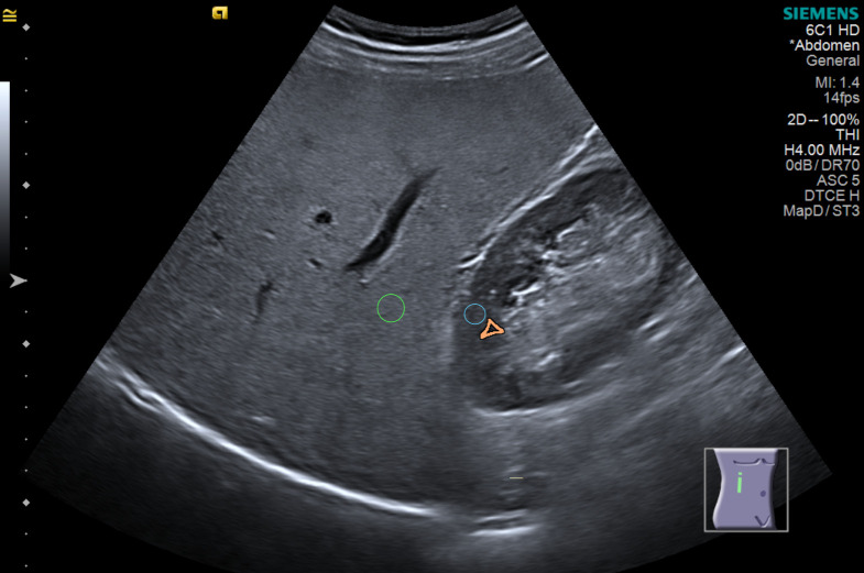 Ultrassom subcostal mostrando fígado esteatótico e rim direito no mesmo corte, com regiões de interesse no parênquima hepático e no córtex renal, na mesma profundidade
