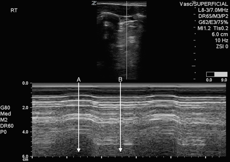 Modo M de ultrassom pulmonar em paciente com doença bolhosa sem pneumotórax, com trechos em código de barras alternando com padrão de praia, imitando um ponto pulmonar